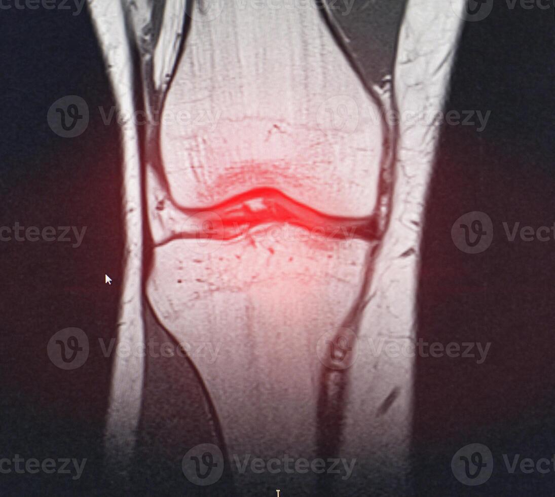A snapshot of the diagnosis of an MRI of the knee in which arthrosis and arthritis. The concept of joint diagnosis using x-rays, treatment of diseases of the knee joint, bursitis photo