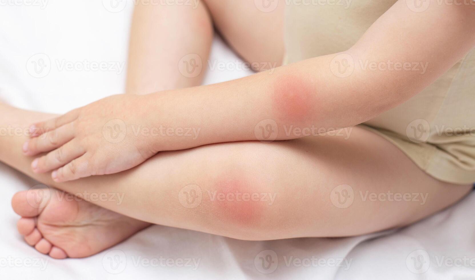 Hands and feet of a young child who has a rash and redness on the skin. The concept of treatment of diseases and skin care in children, background. Dermatology photo