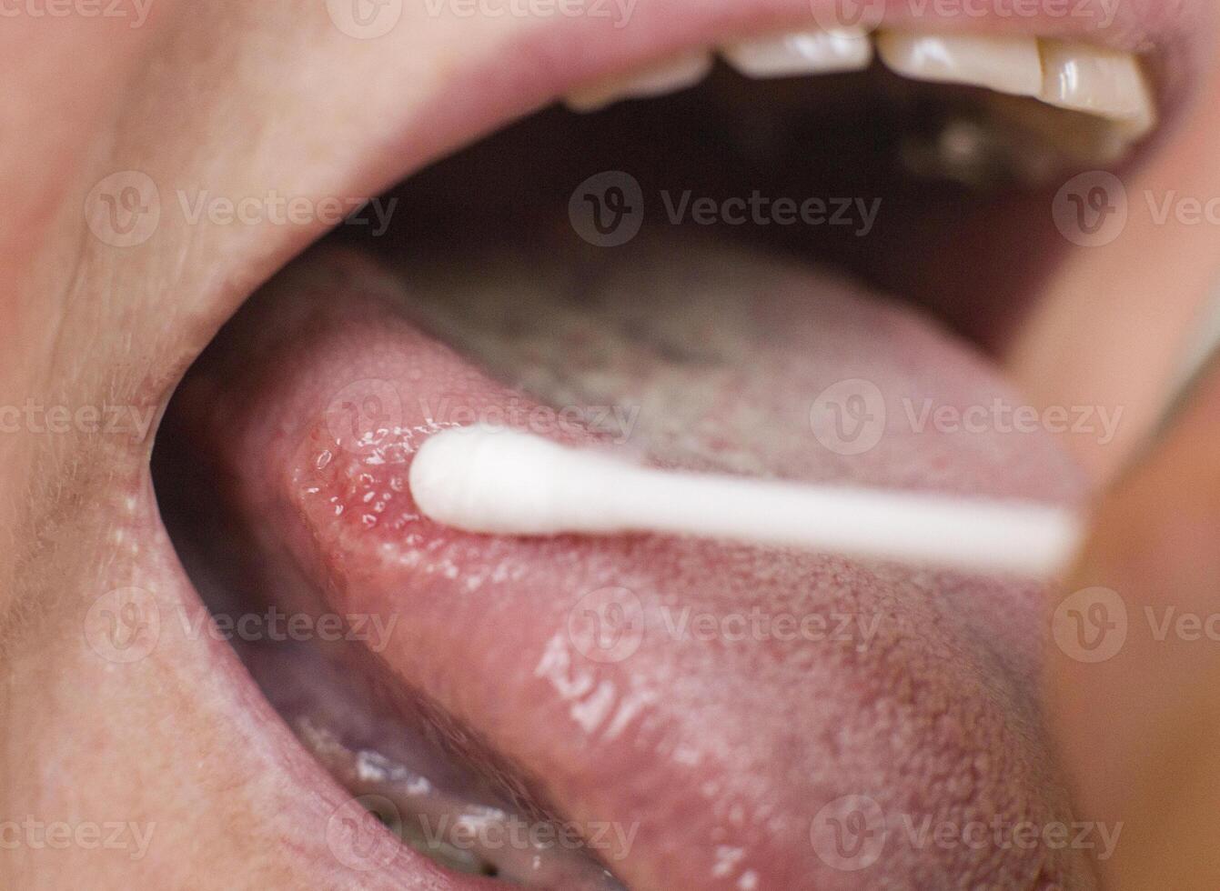 Taking a smear for a disease in the tongue of a woman. Glossitis and gingivitis tongue disease research concept, medical photo