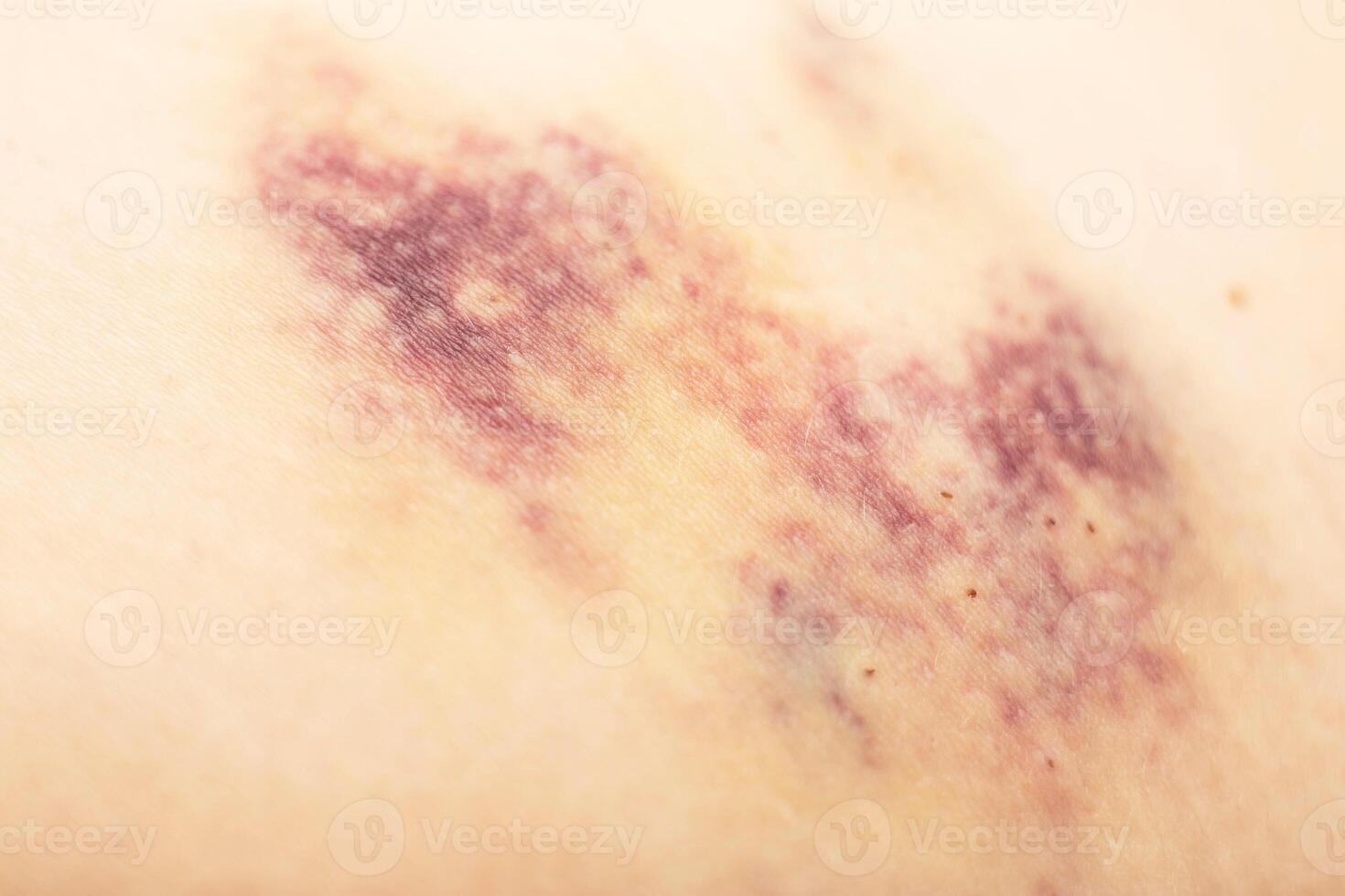 Bruises on the patient's body after injections, bruises under the skin, medical photo