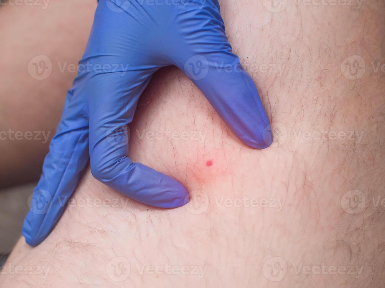 The doctor examines a red spot on the patient s leg after being bitten by an insect. The concept of an allergic skin reaction after being bitten by mosquitoes and bees, close-up, treatment photo