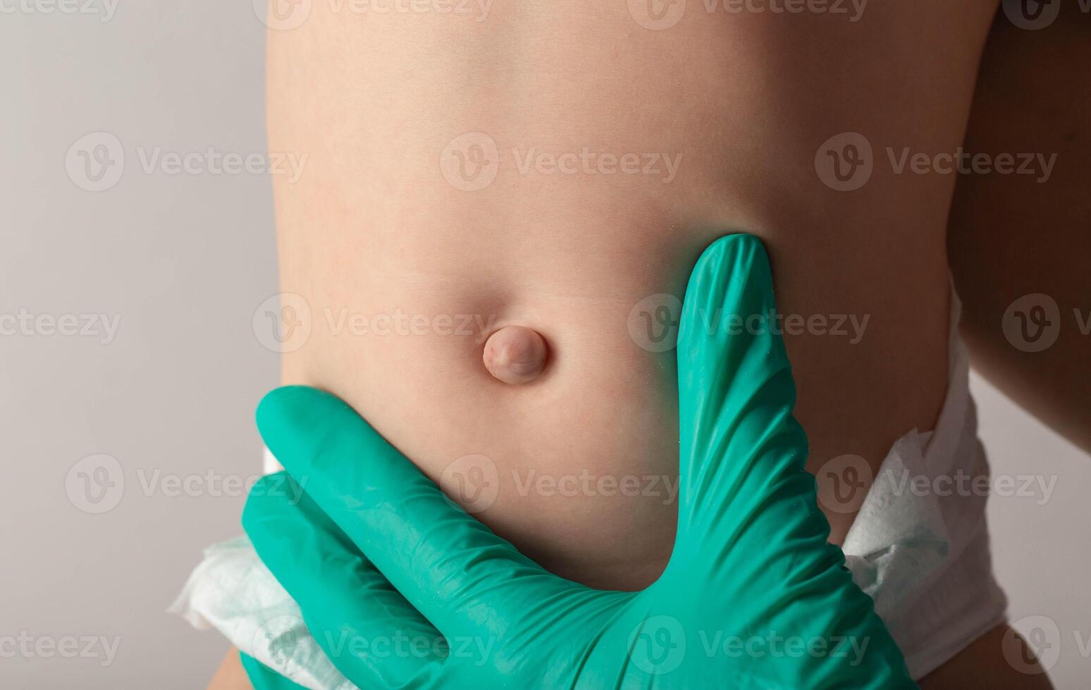 A doctor surgeon in medical gloves examines the abdomen of a newborn baby with an enlarged umbilical ring and an umbilical hernia, close-up, medical photo
