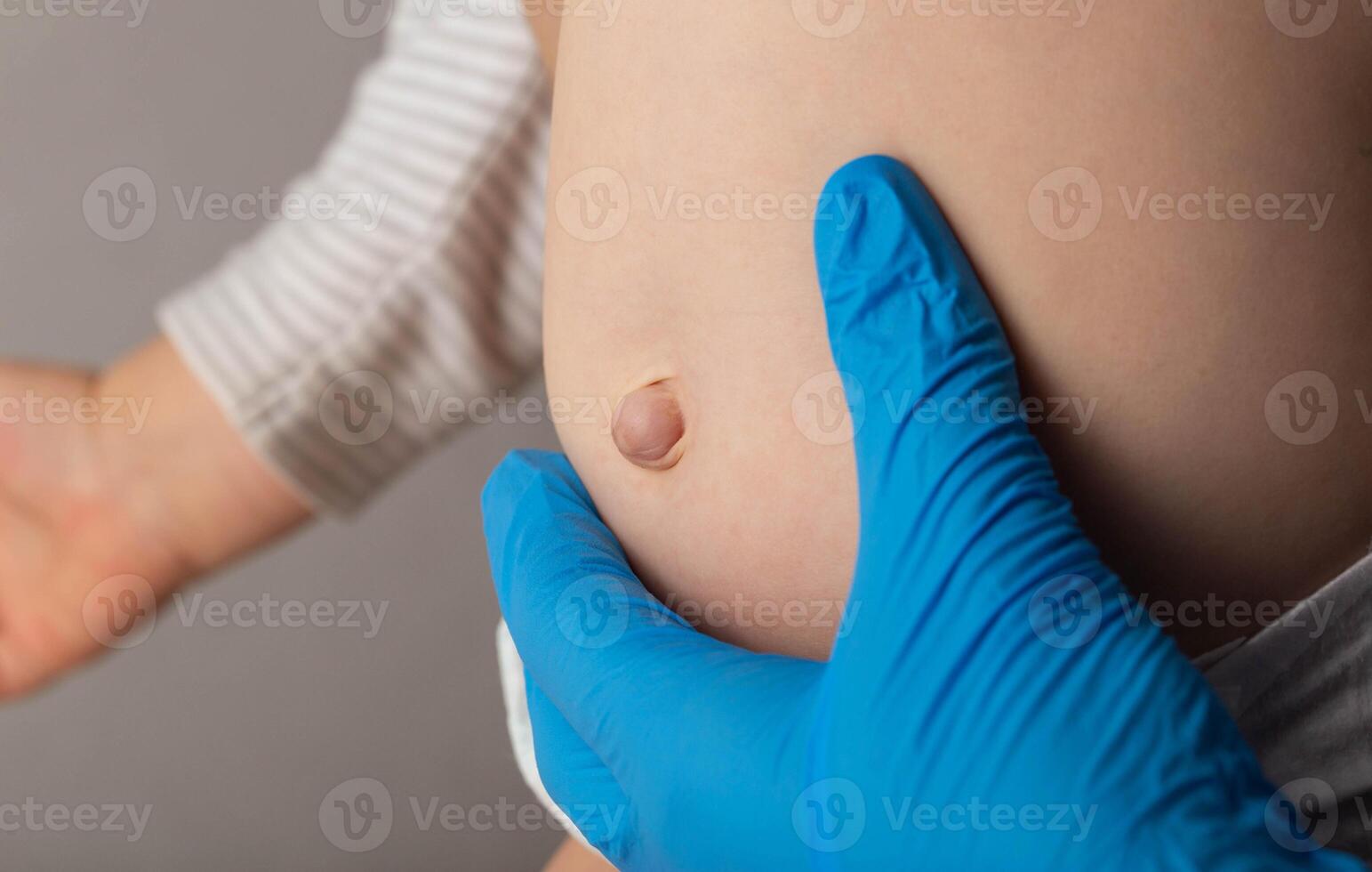 A doctor surgeon in medical gloves examines the abdomen of a newborn baby with an enlarged umbilical ring and an umbilical hernia, close-up, medical photo