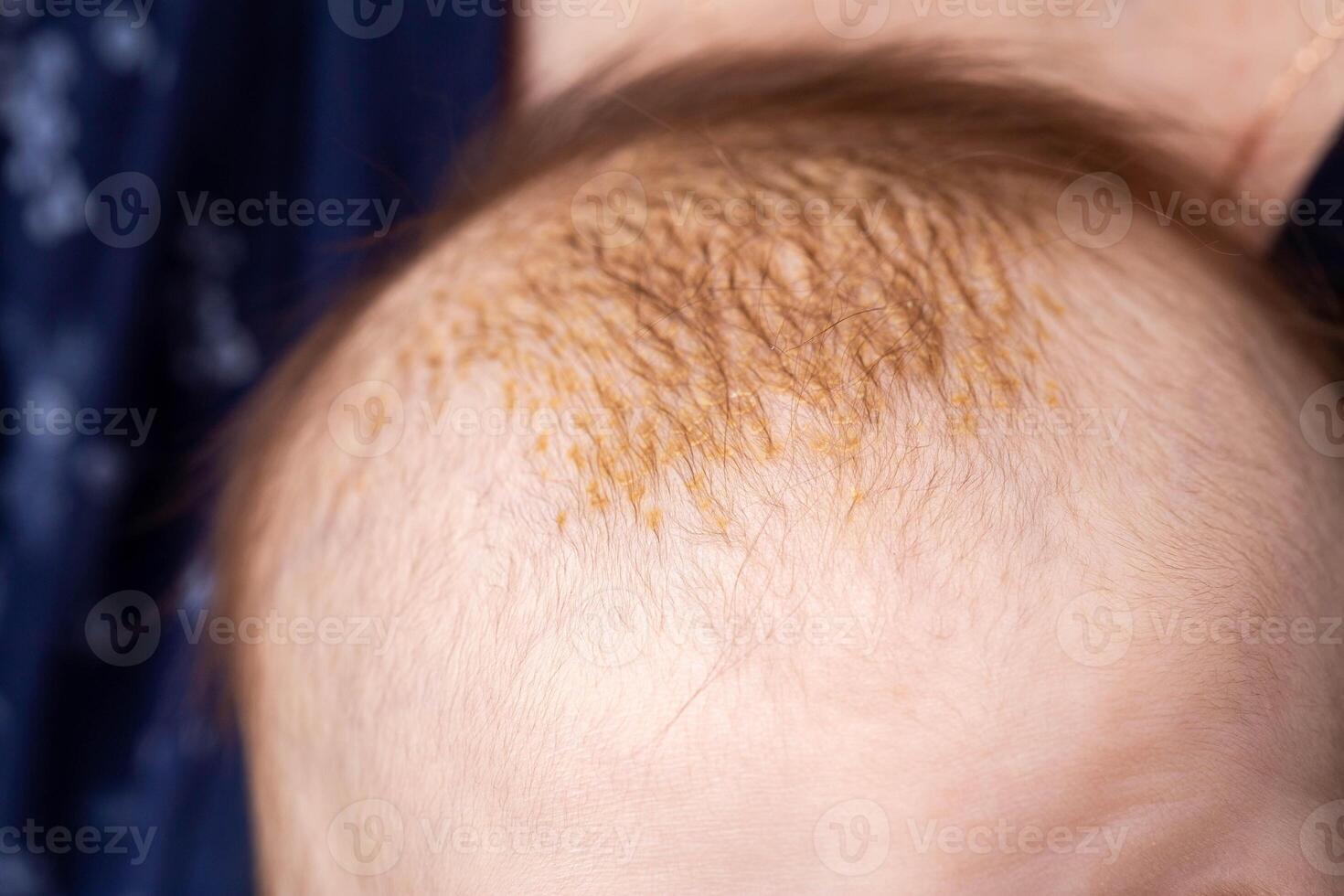 Milk crusts on the head of a newborn child, gneiss. The formation of yellow-golden scales on the head of an infant, close-up photo