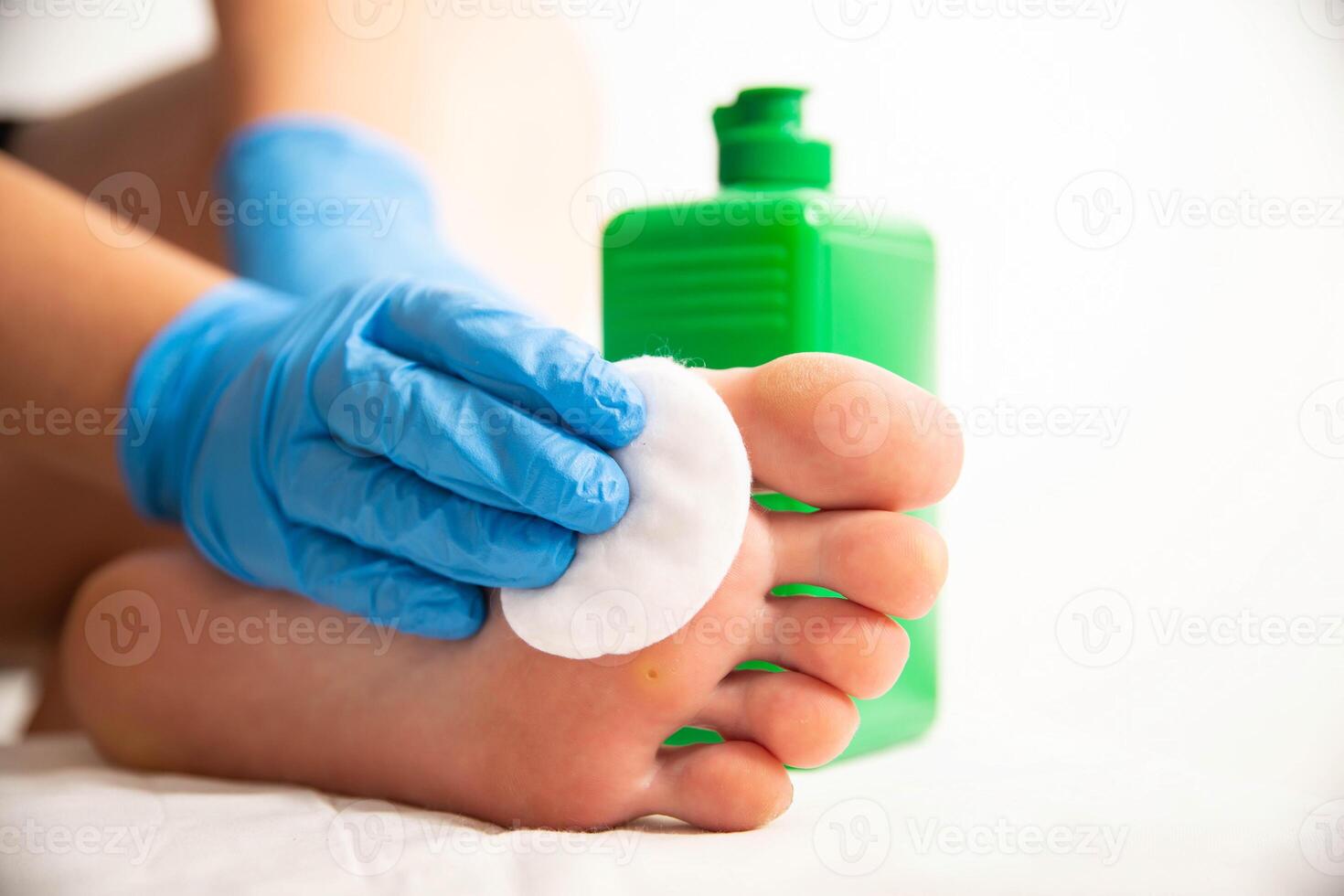 The doctor uses a special liquid to burn a removed callus on the foot. Surgical removal of calluses and warts, close-up photo