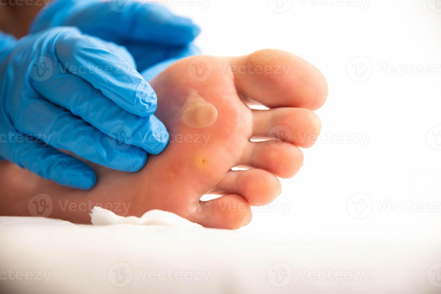 A doctor examines the foot of a person who has a large callus and a stem wart. Treatment and removal of warts and corns, close-up photo