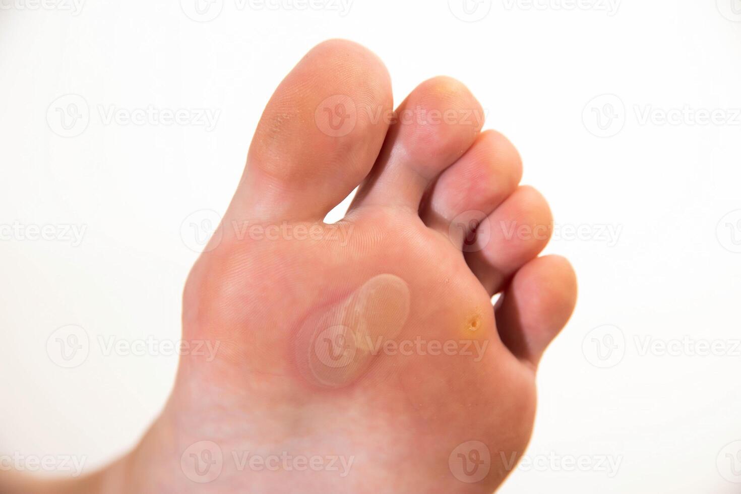 Human foot with a large callus and chicken jowl wart on a white background, close-up. Human papilloma virus photo