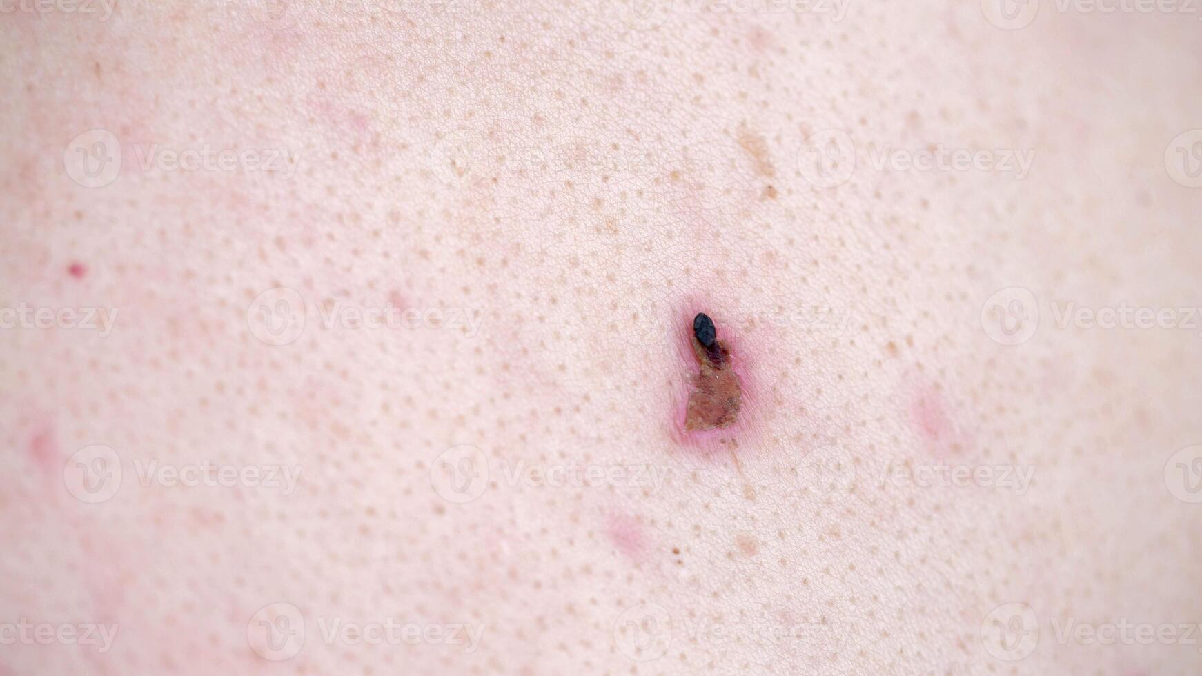 removal of papilloma on human skin, cauterization of warts with a laser. Copy space for text, dermatology photo