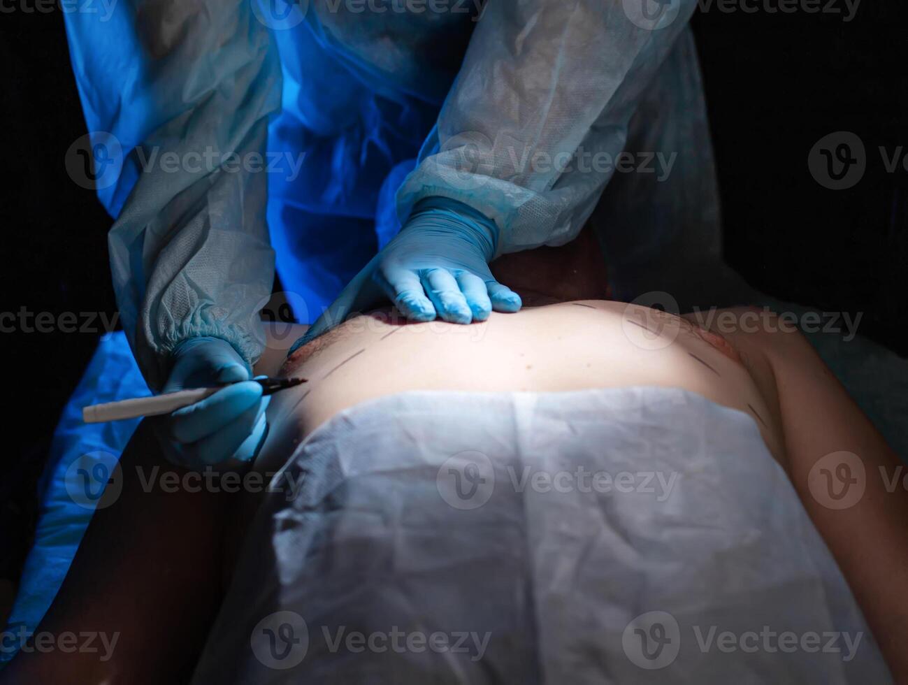 Plastic surgeon doctor prepares for breast reduction surgery on a man, close-up. Liposuction photo