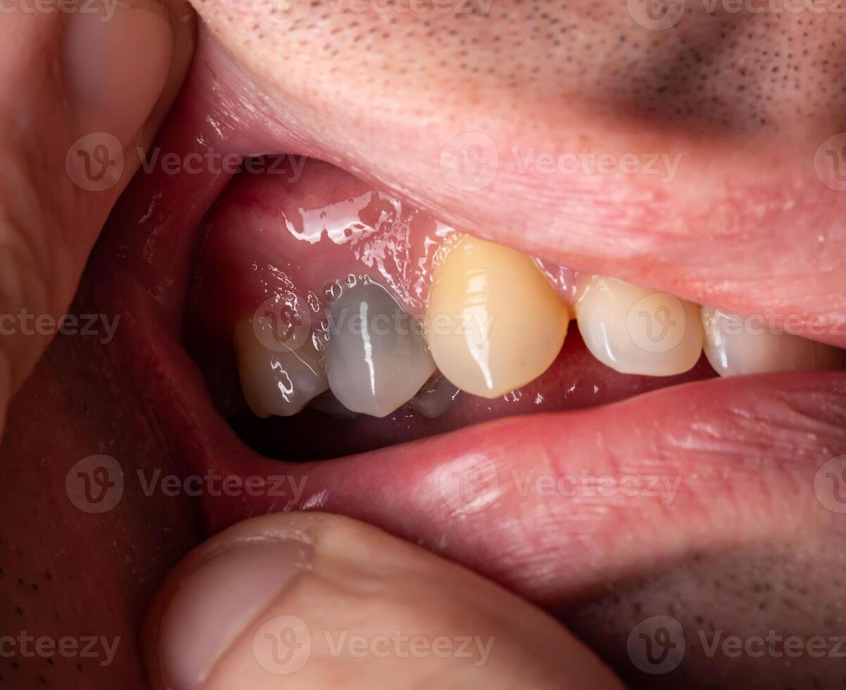 A black tooth in a man's mouth after removal of a nerve and filling of dental canals with low-quality materials. Tooth whitening, close-up photo