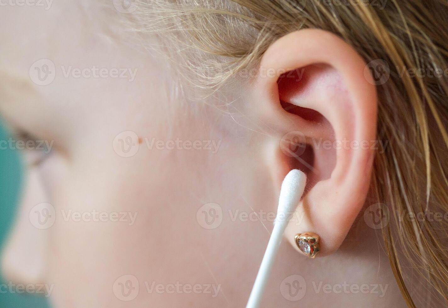 Cleaning the ears of a 5-year-old child from sulfur with cotton swabs, close-up. Hygiene procedure. photo