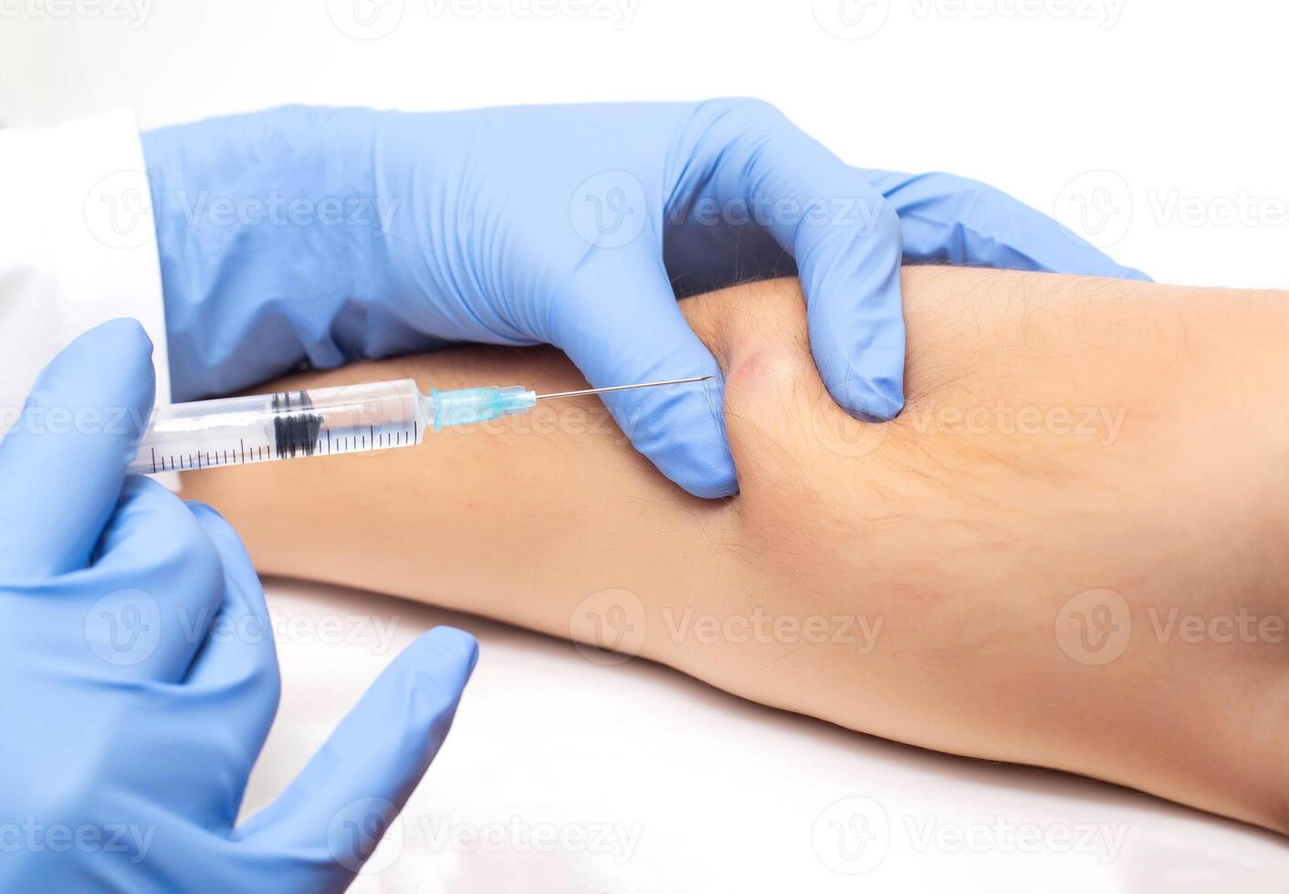 The doctor uses a syringe to take a skin biopsy from the patient. The concept of malignant subcutaneous lesions, close-up photo
