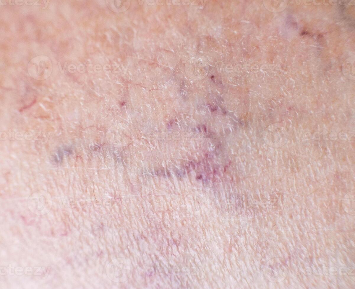 Vascular asterisk on the patient s skin. The concept of varicose veins in humans, background, macro, phlebeurysm photo