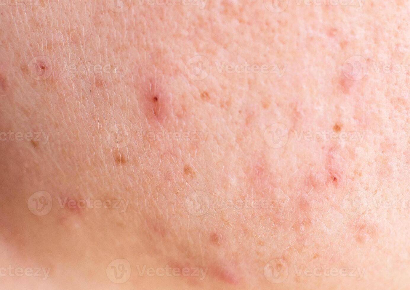 Red acne on the girl's face, background, macro photo