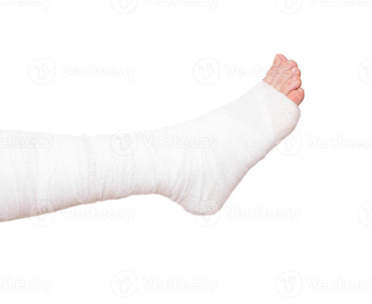 Leg bandaged in a tight dressing, plaster cast for fracture of the leg and ankle joint, isolate photo