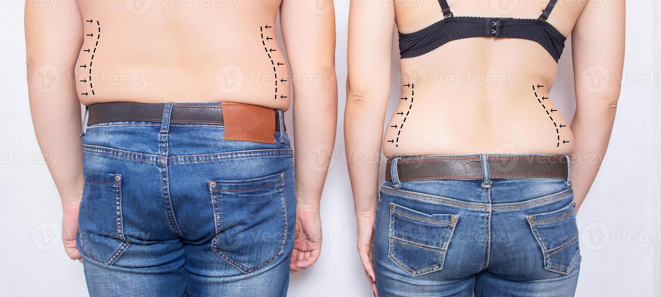 Married couple man and girl with obesity on their sides. Concept of plastic surgery to remove fat on the abdomen and sides, liposuction, beauty saloon photo