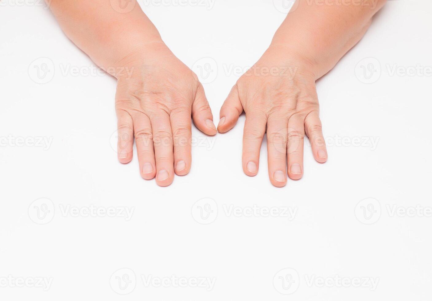 Dry skin with wrinkles on the hands of an elderly woman, white background, isolate. Fragility of blood vessels, vitamin deficiency, copy space photo