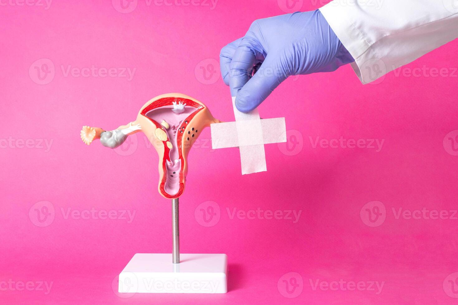 Doctor holding a medical plaster near the layout of the female reproductive system on a pink background. Concept of surgical operations for women, intimate plastics, correction of the labia photo