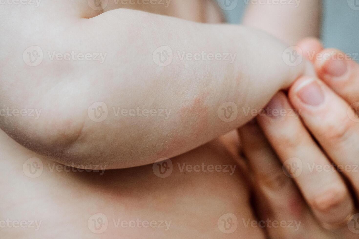 Redness of the skin on the child's body, psoriasis is a childhood disease, an allergic reaction to food, eczema spots, neurodermatitis. photo