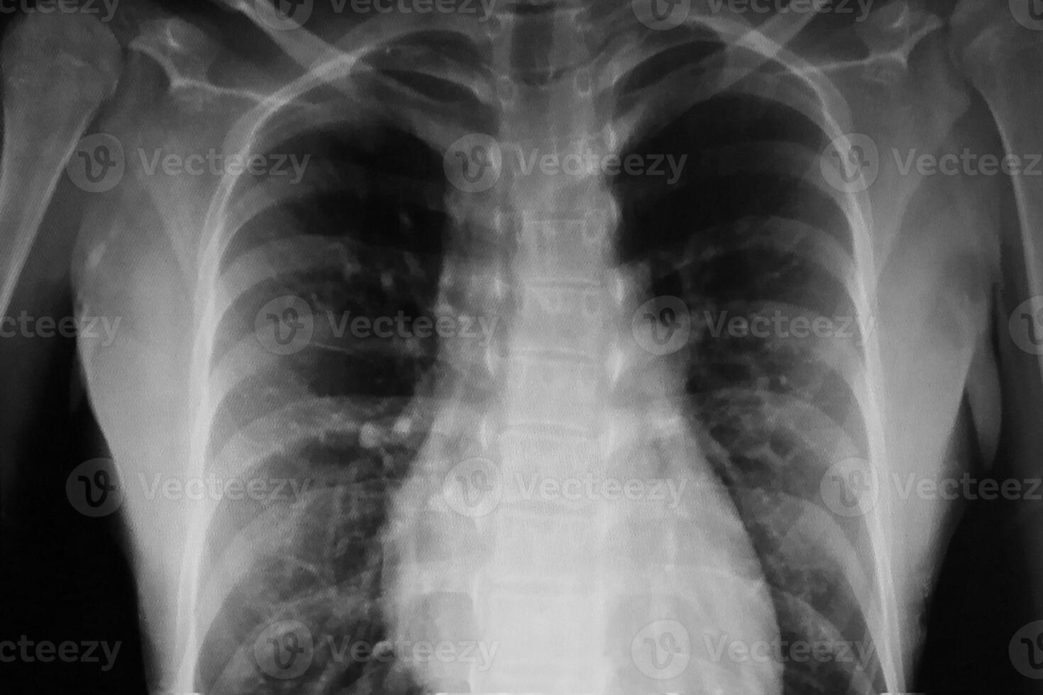 Black and white torso X-ray film image photo