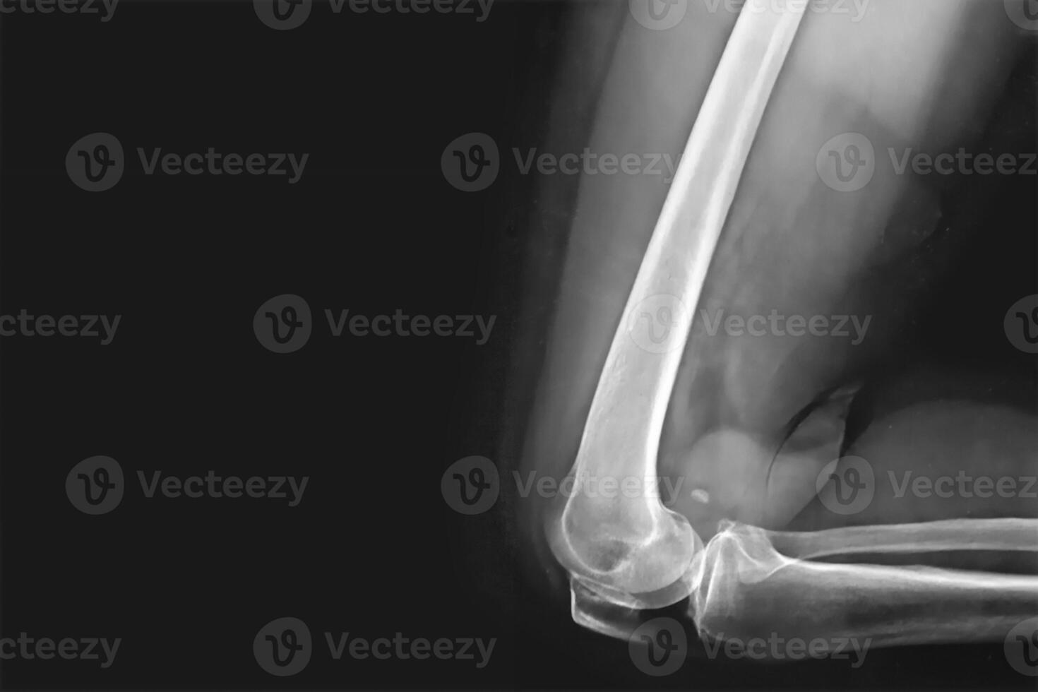 Black and white X-ray film of the knee and leg. photo