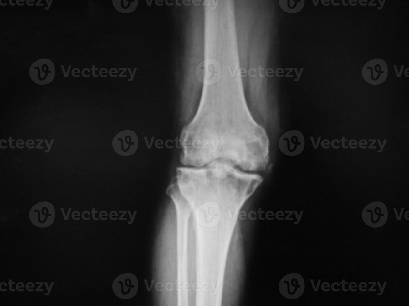 Black and white X-ray film of the knee and leg. photo