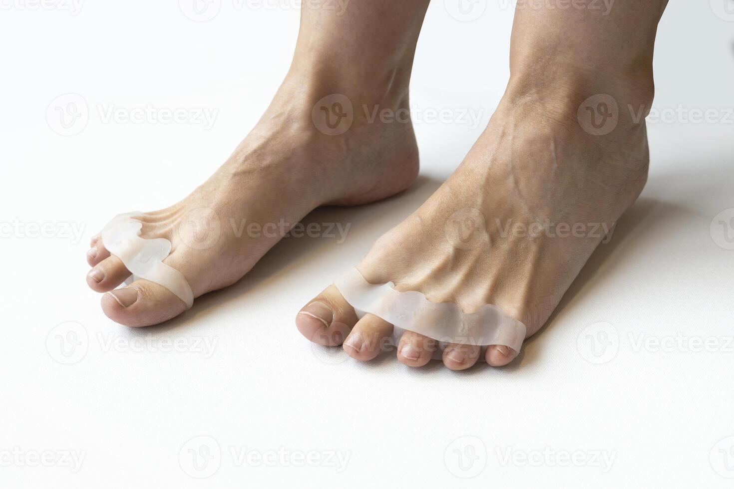 Bunion, hallux valgus. Silicone finger toe separator on feet isolated on white background. preparing for foot pedicure at home with nail separators photo