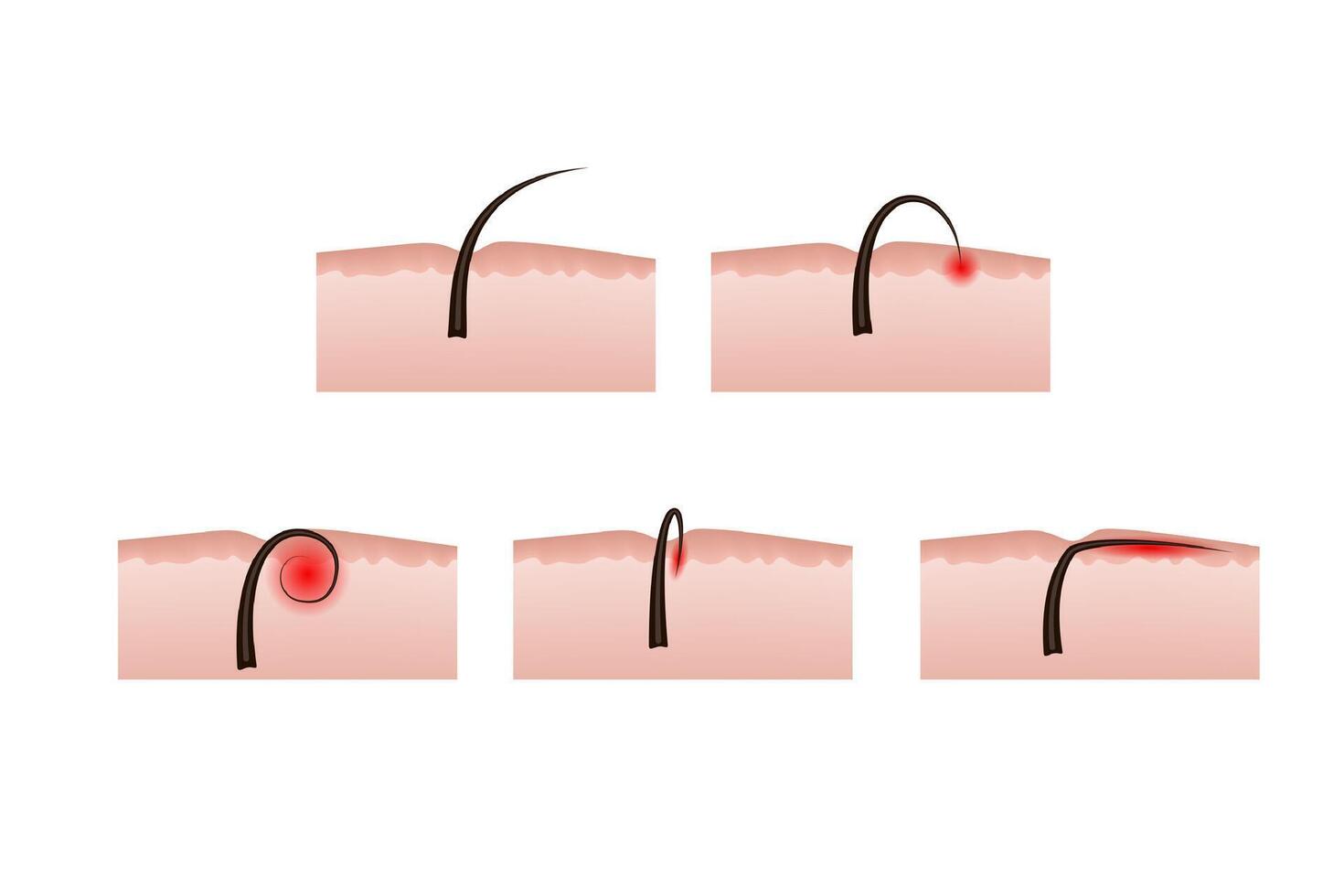 Ingrown hairs after depilation. Skin structure. vector