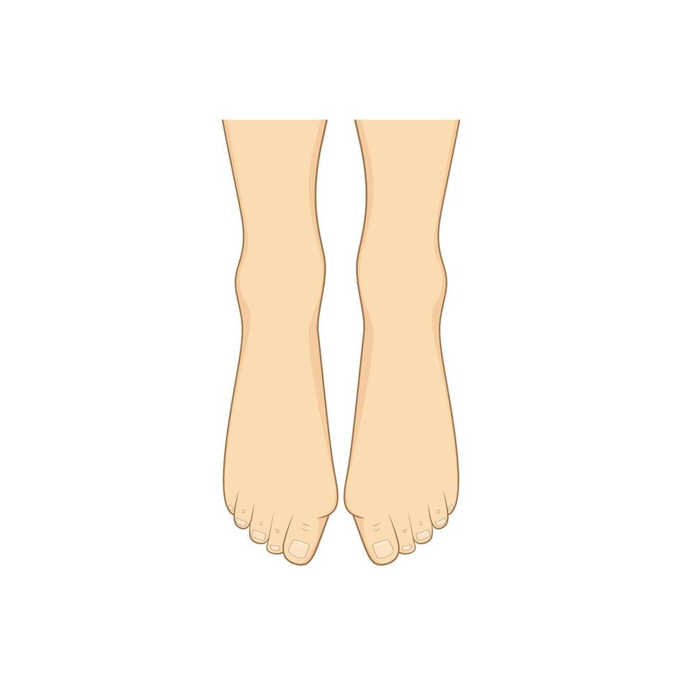 Hallux valgus, bunion. Problem with foot vector