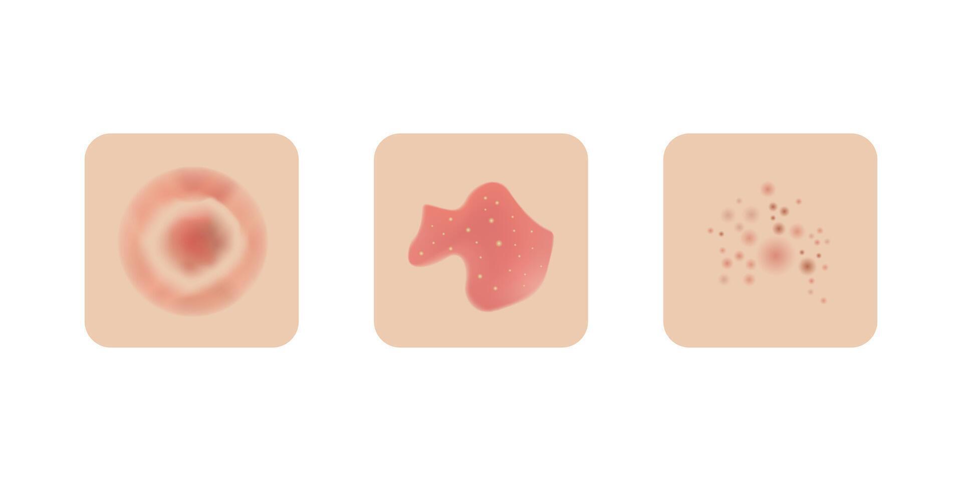 Skin allergy examples design, dermatology problems. Red rash and spots, itchy, swollen redness. vector