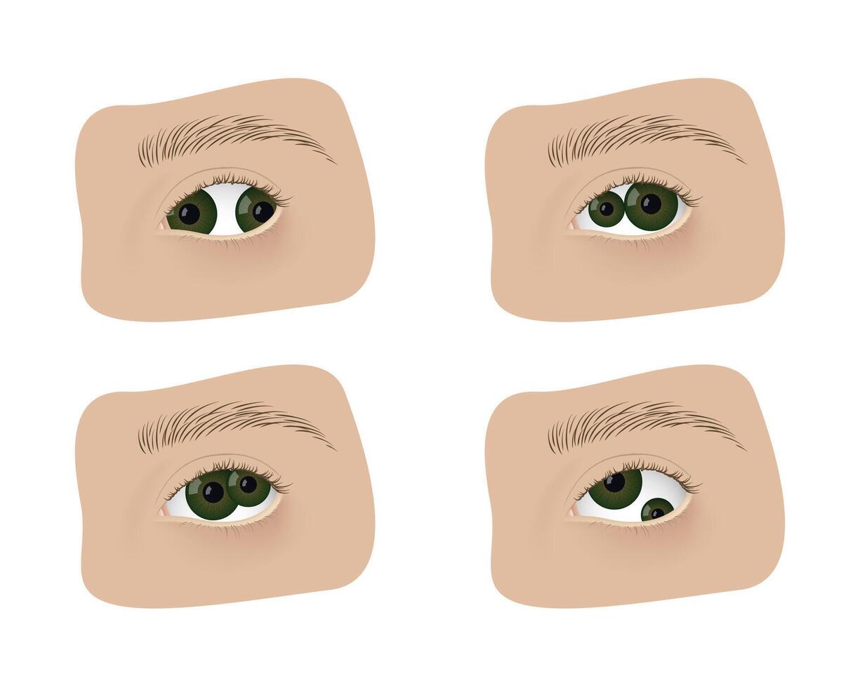 Realistic human eyes with pupula duplex. Human mutation, anatomy, health. vector