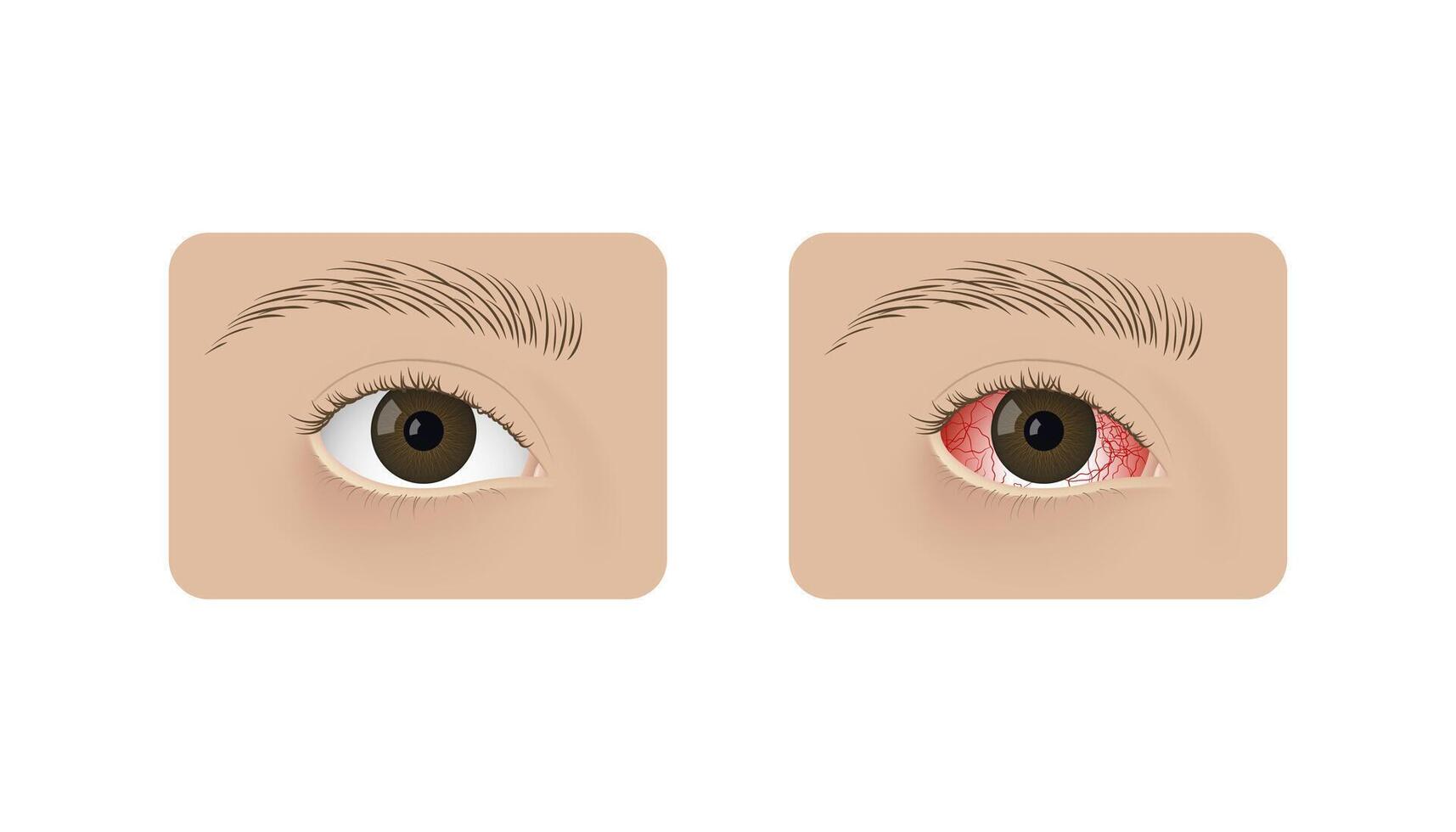 Realistic human healthy eye and with conjunctivitis Red dry eye syndrome, anatomy, health and allergies. vector