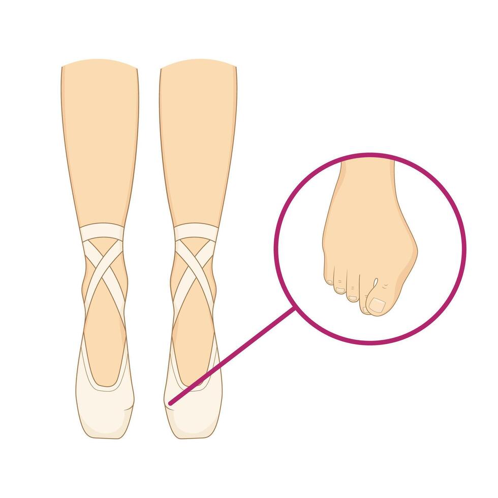 Professional ballerinas bunion illness. The dancers legs are barefoot and in pointes. Orthopedics hallux valgus vector