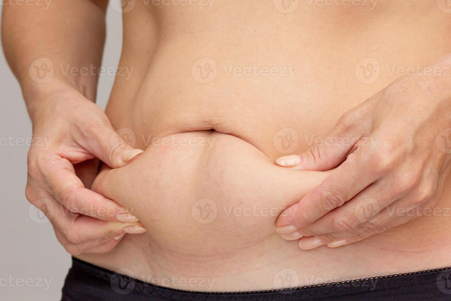 Hands on belly pressed skin to show sagging skin after diet and stretch marks after pregnancy photo