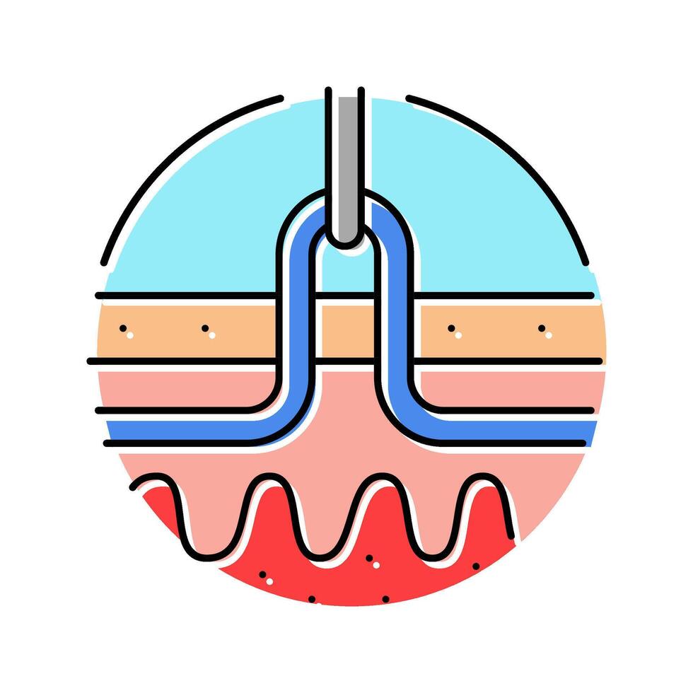 percutaneous nephrolithotomy color icon illustration vector