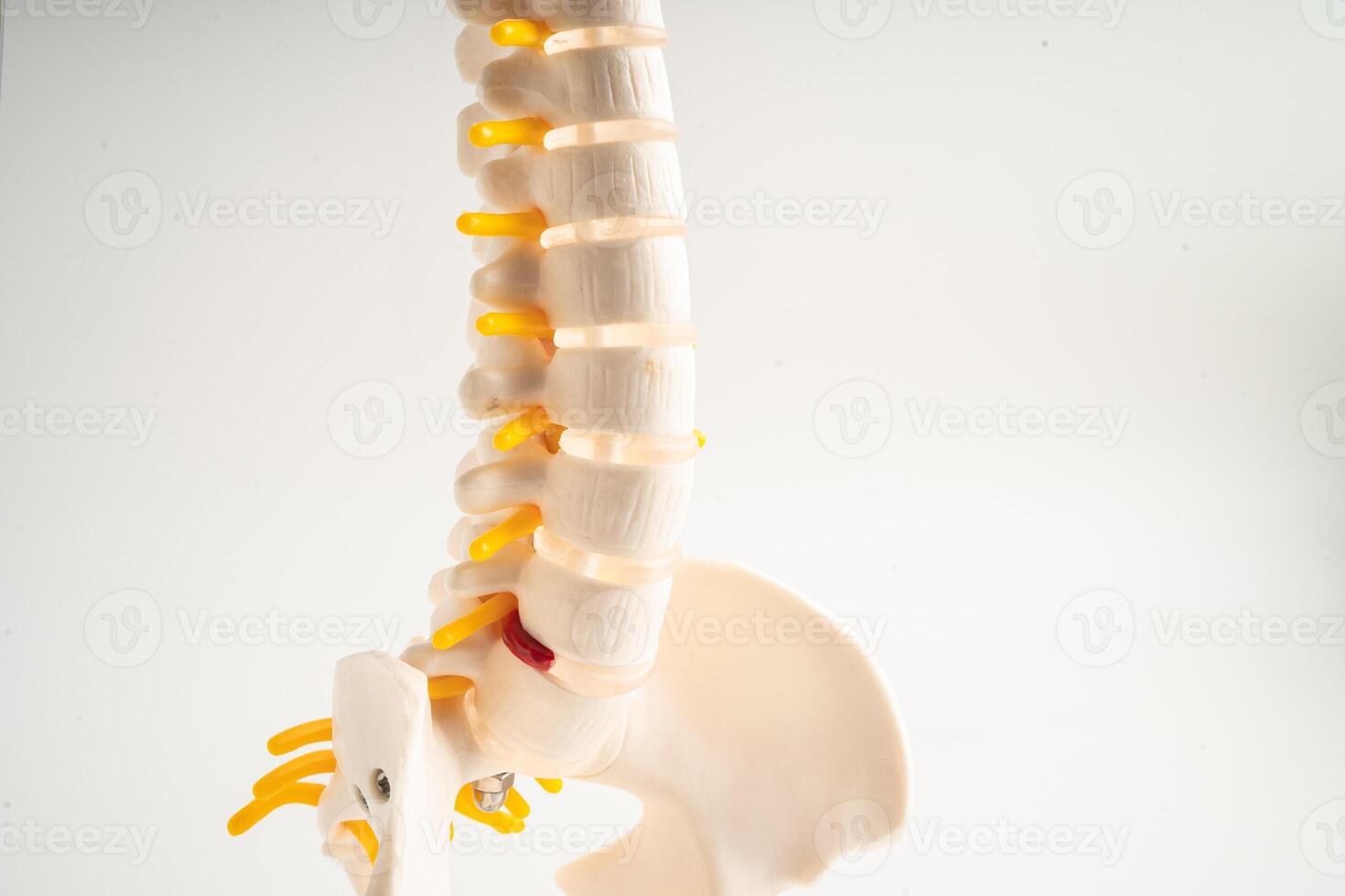 Lumbar spine displaced herniated disc fragment, spinal nerve and bone. Model for treatment medical in the orthopedic department. photo