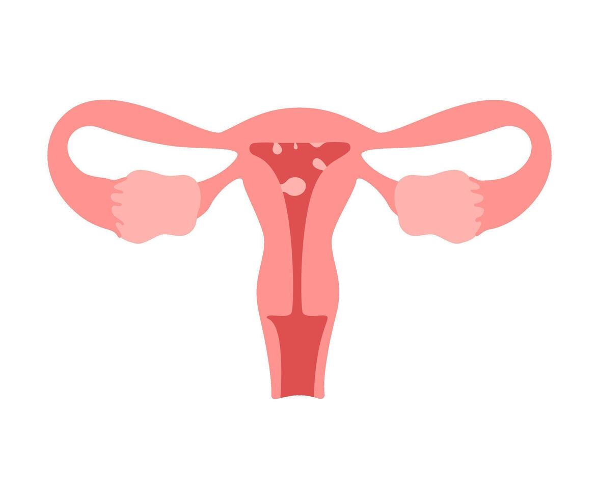 Uterus organ with polyp. Check health of woman organ. Unhealthy, internal problems, female reproductive system disease. Risk growth cancer cells in womb. flat illustration vector