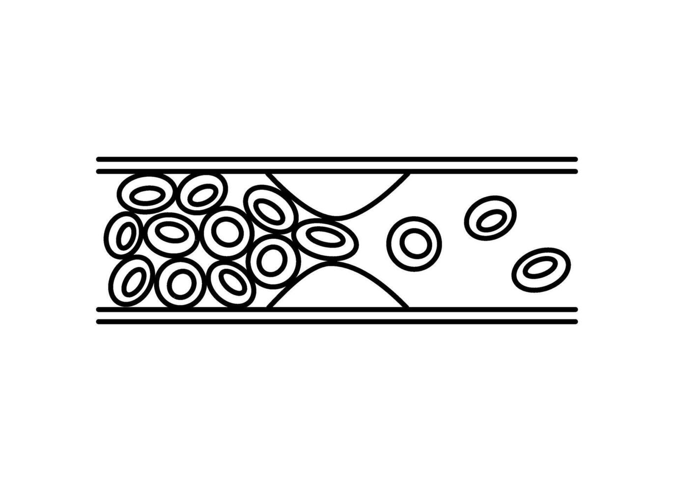 Deep vein thrombosis DVT, artery and vein disease with fat cells, line. Abnormally of blood vascular flow. Cholesterol in blocked in human blood vessel. illustration vector