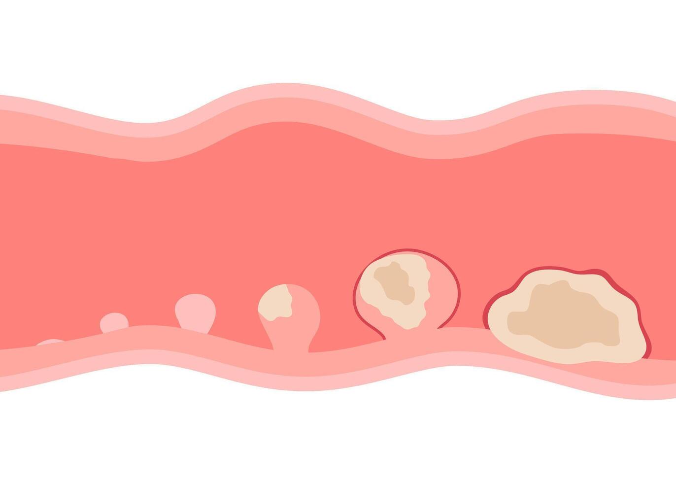 Stage of growth polyp in malignant tumor inside wall of organ. Risk cancer human digestive system organ. Colon cancer cells. Flat illustration vector