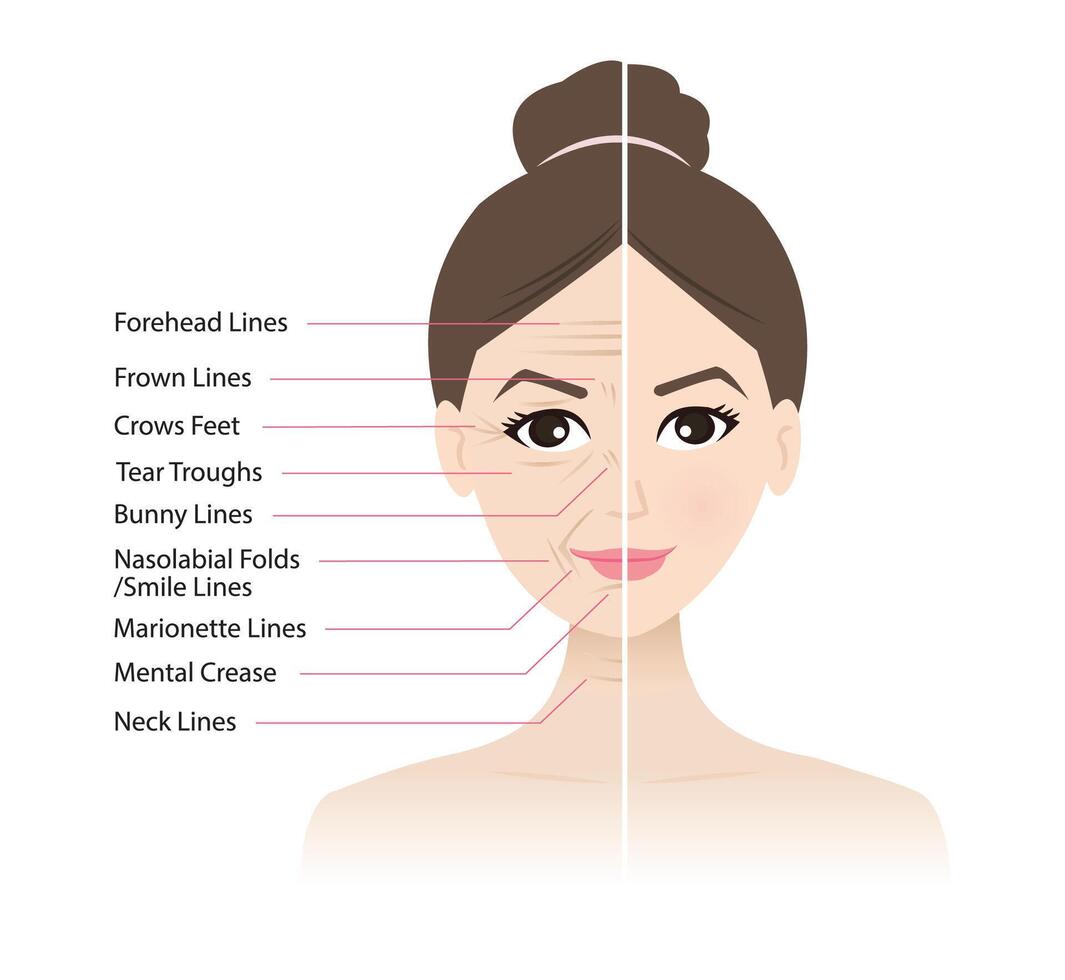 Comparison before and after facial wrinkles on woman face illustration. Forehead, Bunny, Marionette, Frown lines, Mental crease, Crows feet, Tear troughs, Nasolabial folds, Smile, Neck lines. vector
