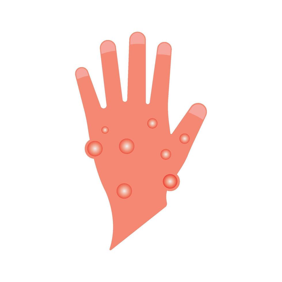Skin rash, insect bites allergy reaction. irritation on hand logo illustration vector