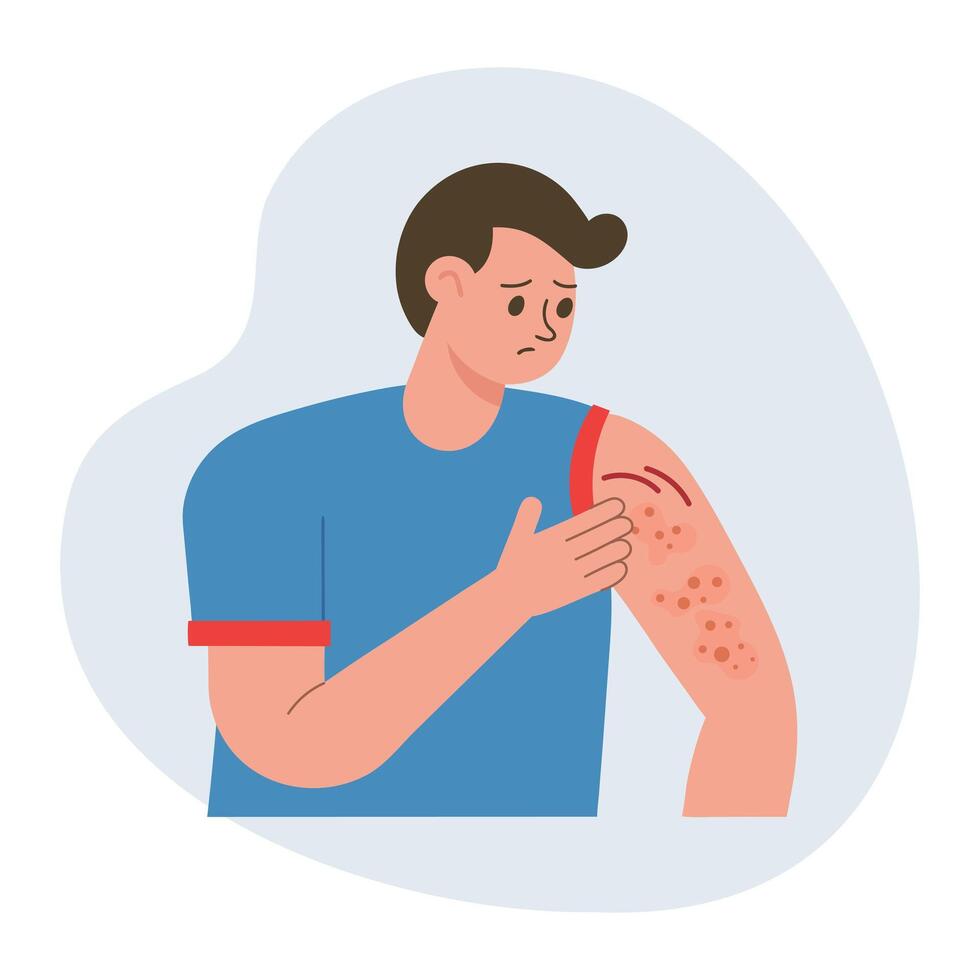 Man scratching his hand. Allergic itching, skin inflammation, redness and irritation. Atopic dermatitis, eczema. Healthcare and medicine. vector