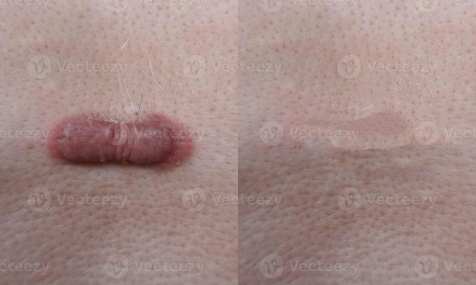 Keloid scars before and after treatment. photo