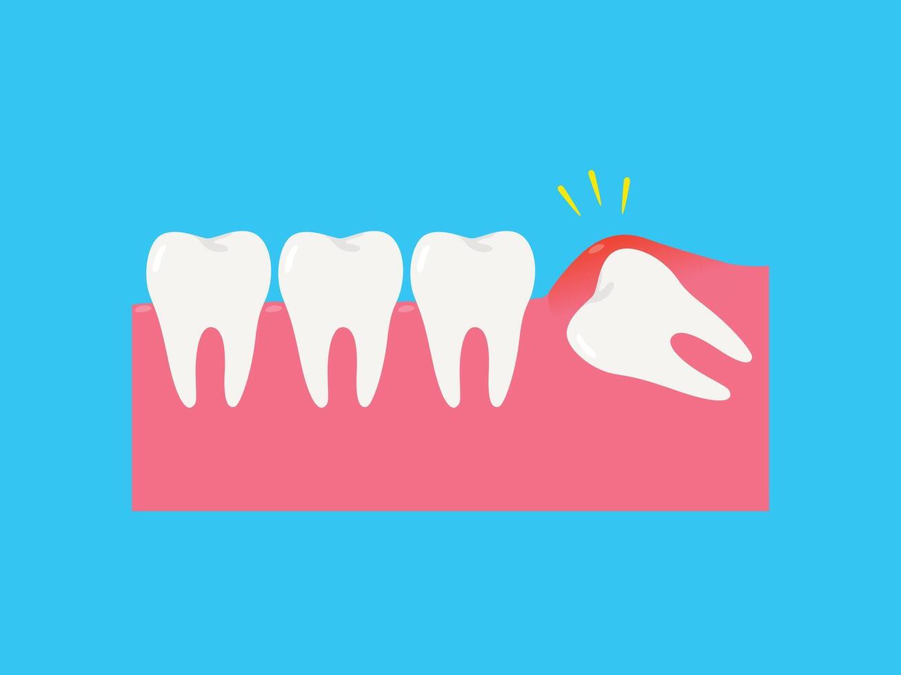 Illustration of wisdom teeth under the gums cause pain in the mouth vector