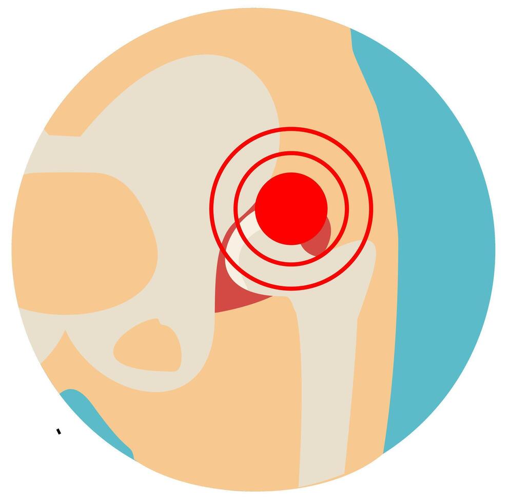 Hip Osteoarthritis icon. Flat style. Front view of hip joint with section of the pelvis. Lower back and joint pain. Medical, healthcare vector