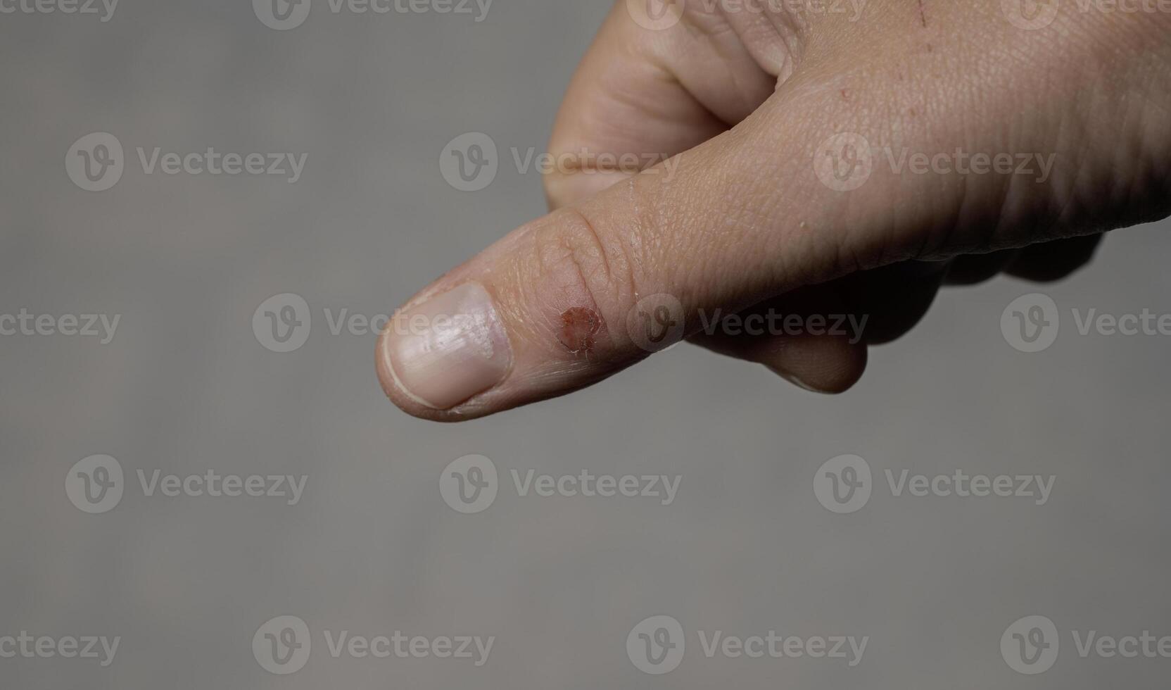 there is a fresh wound on the thumb photo