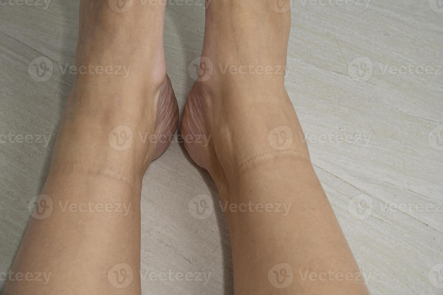This ring around calf after take off sock photo