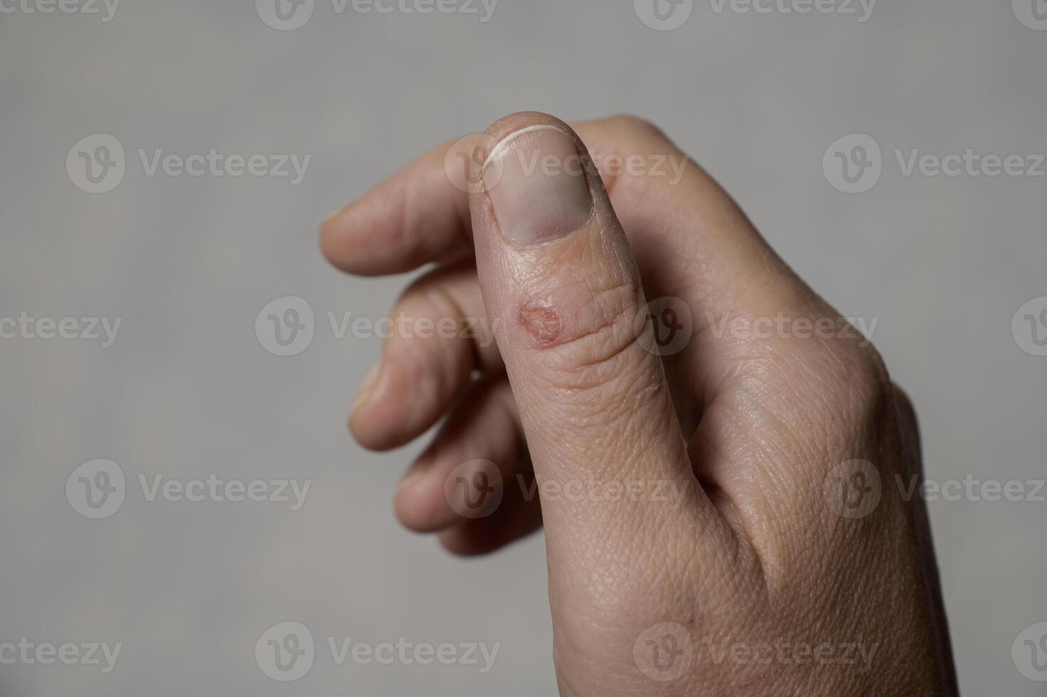 there is a fresh wound on the thumb photo