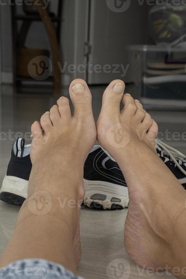 Swollen ankles and swollen feet after wearing sports shoes photo