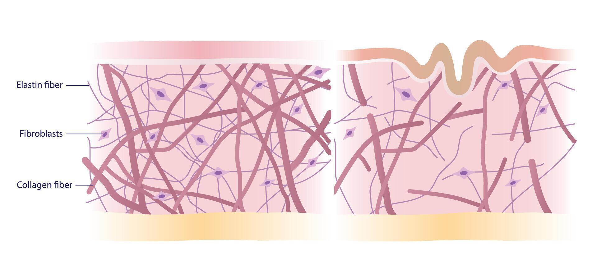 Cross section of skin layer with intact and damaged collagen, elastin fibers and fibroblasts in the dermis illustration on white background. Comparison of young healthy and aging wrinkled skin. vector